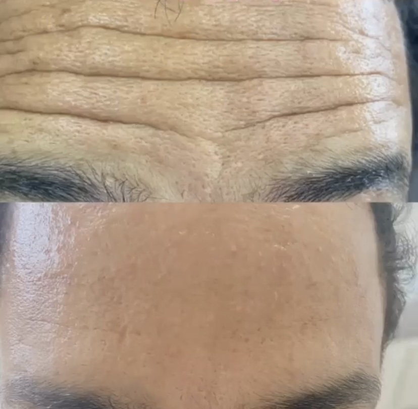 Transformation avant/après FOTONA casablanca médecin esthétique Casablanca