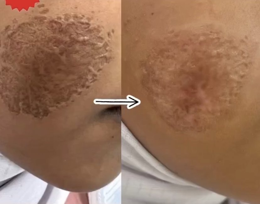 Transformation avant/après FOTONA casablanca médecin esthétique Casablanca