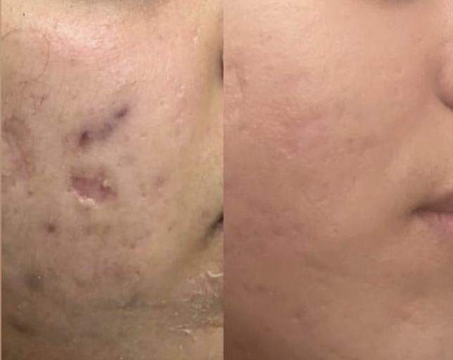 Transformation avant/après FOTONA casablanca médecin esthétique Casablanca