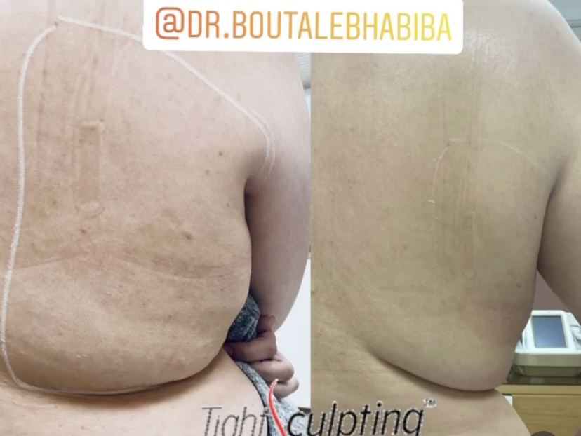 Transformation avant/après FOTONA casablanca médecin esthétique Casablanca