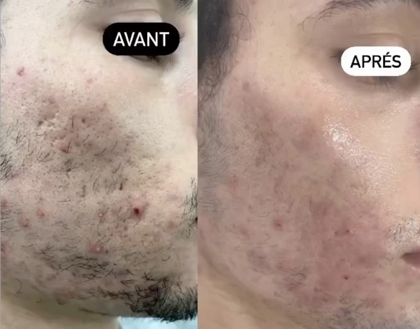 Transformation avant/après FOTONA casablanca médecin esthétique Casablanca